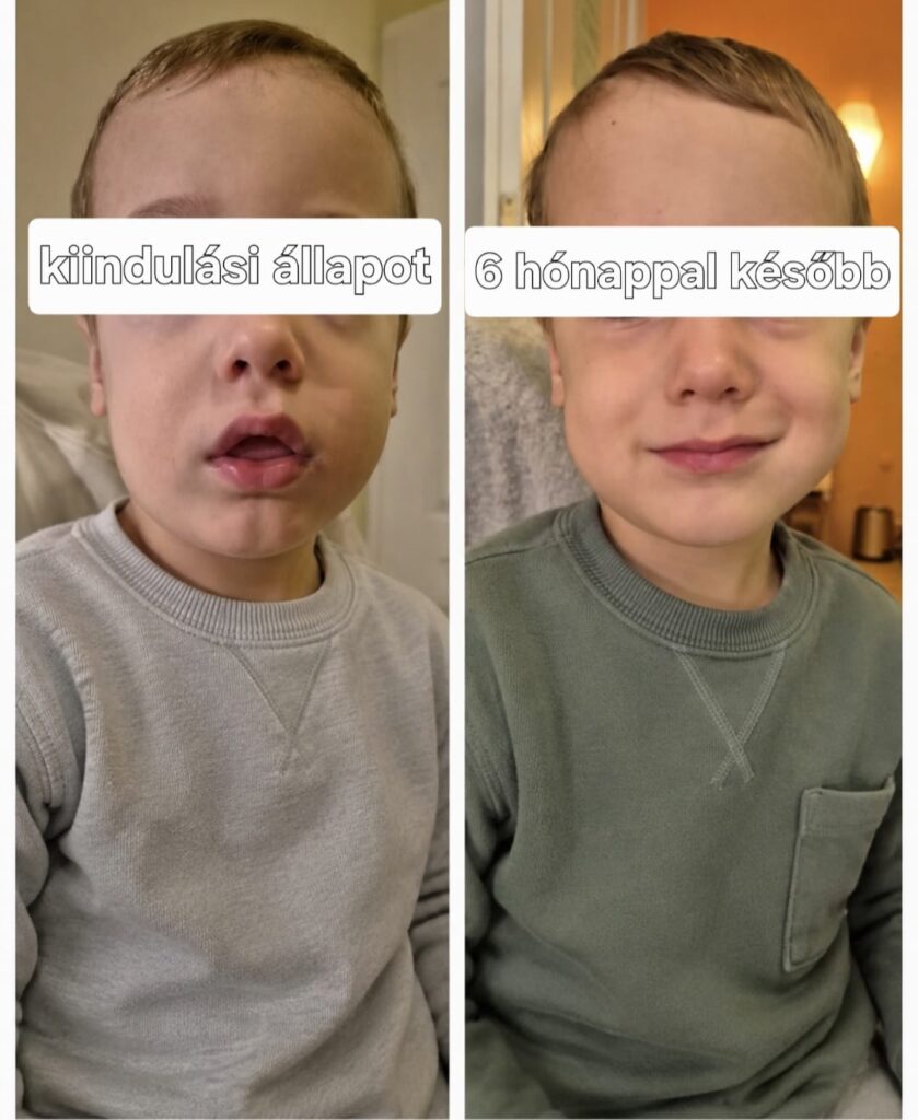 Kiindulási állapot és 6 hónappal későbbi állapot
