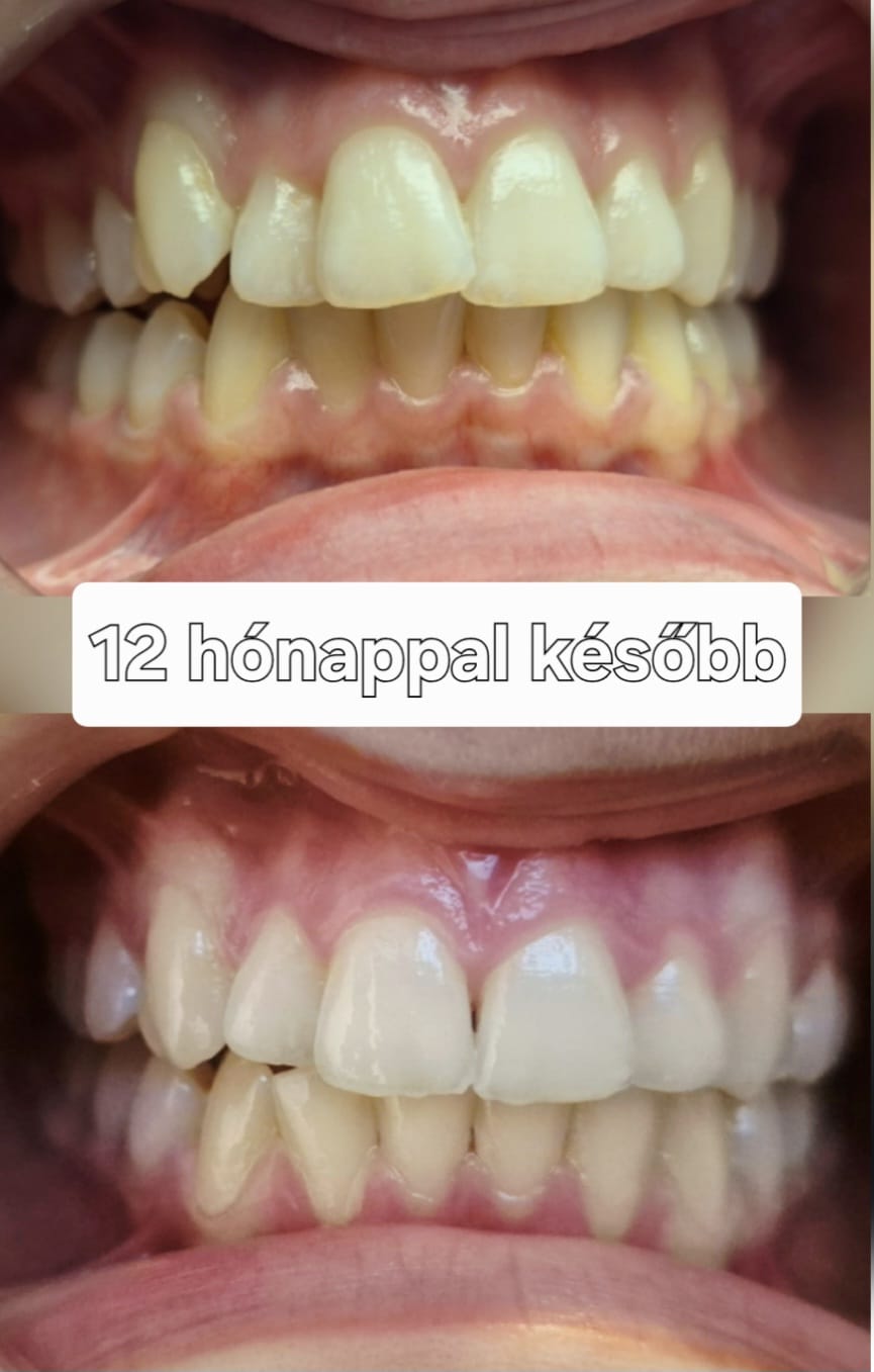 Frontrégió a kezelés kezdetén és 12 hónappal később