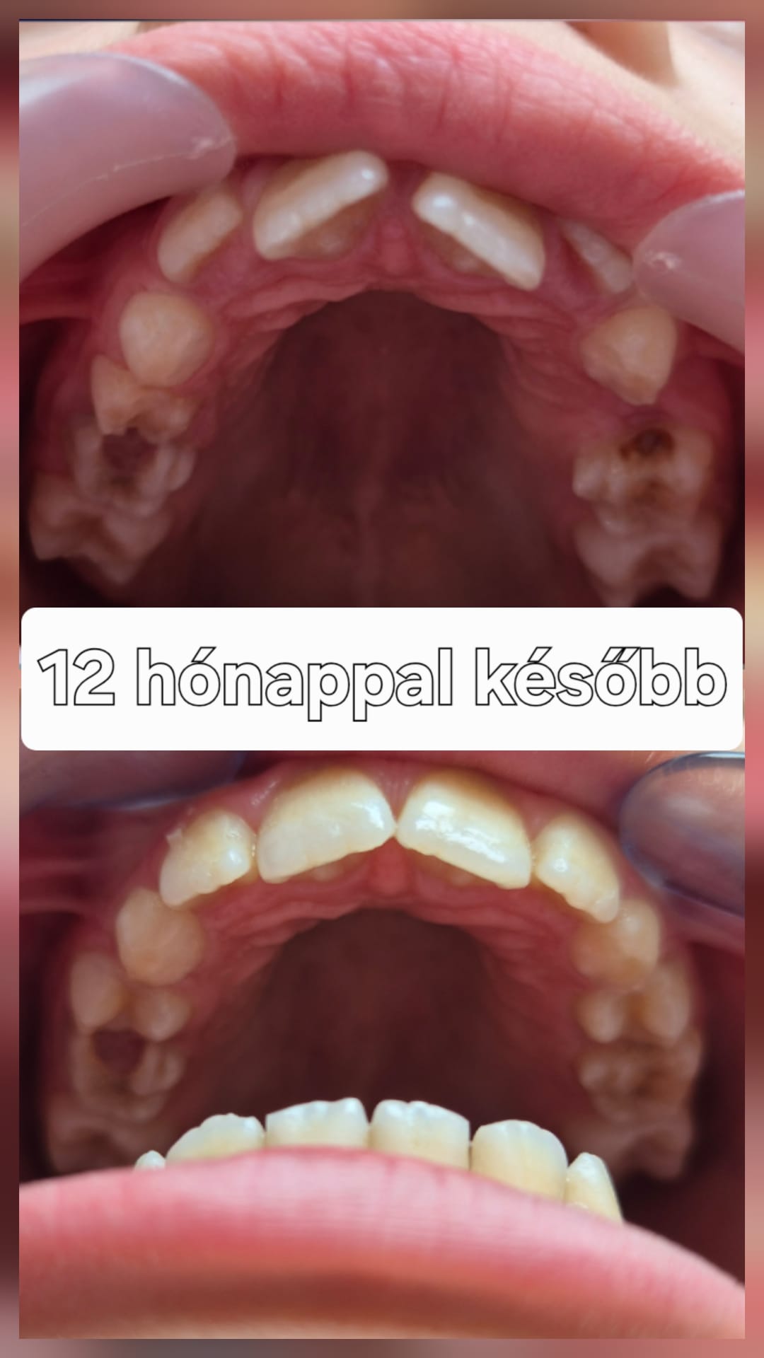 Szájlégzés – kiindulási állapot és kontrollállapot 12 hónappal később