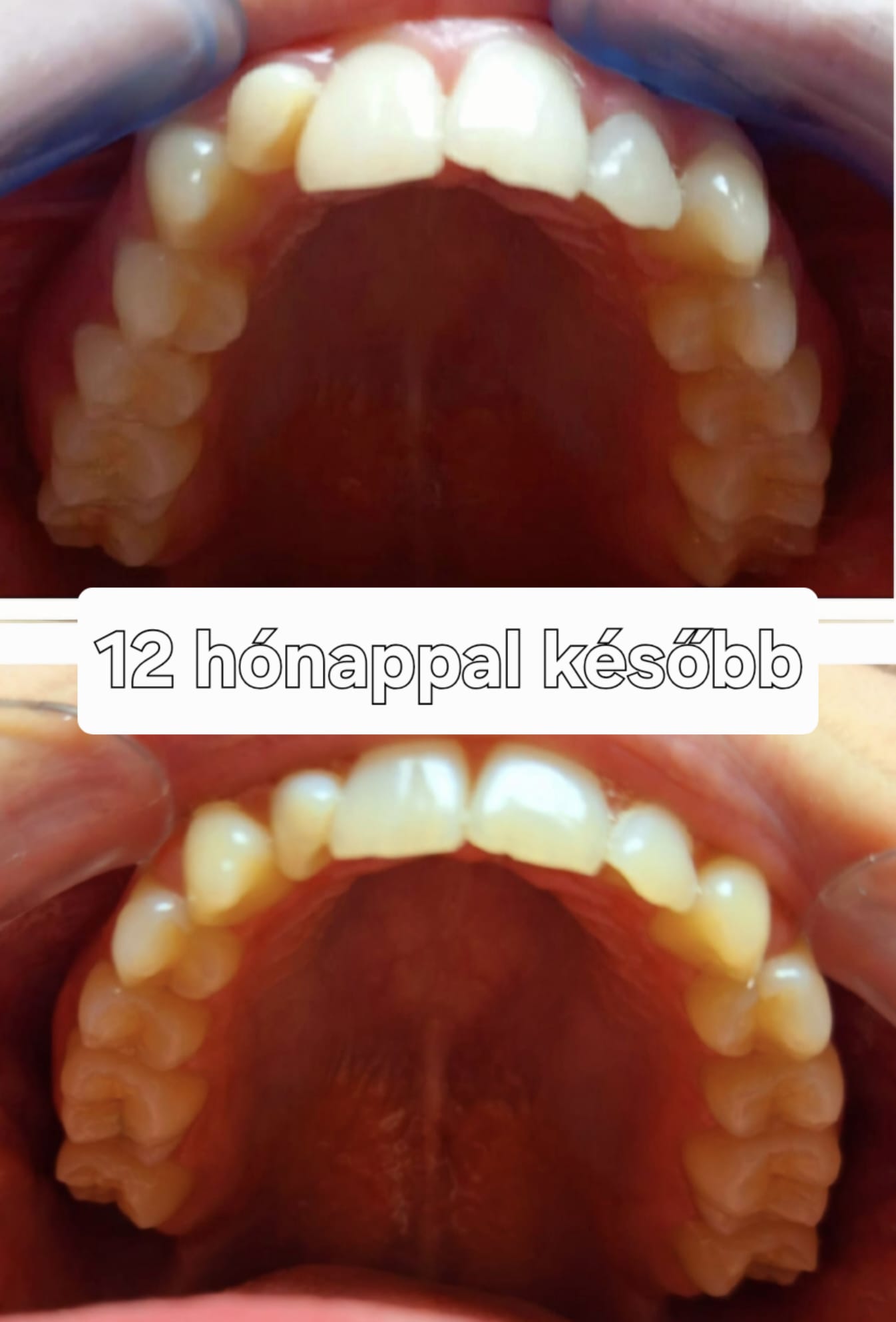 Szorongás oldás – kiindulási állapot és kontrollállapot 12 hónappal később