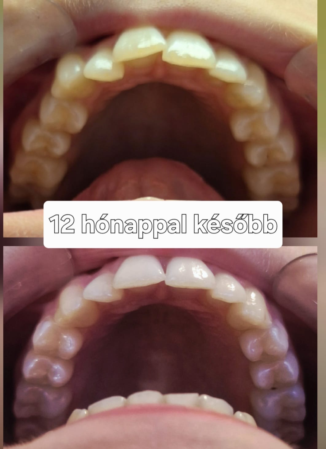 A felső fogív és a szájpad fejlődése 12 hónap alatt